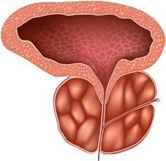 Prostat vəzinin böyüməsi